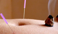 Bild von Akupunktur